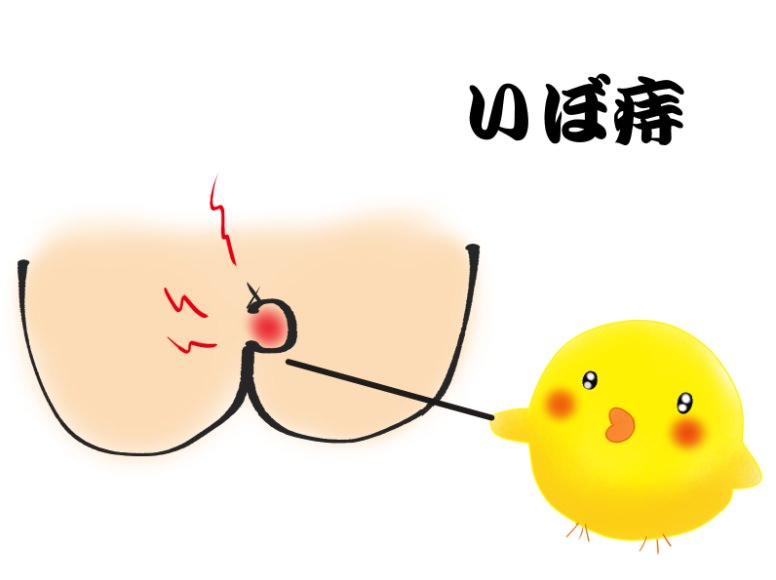 痔 種類 症状