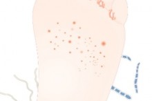 冬の水虫 対策