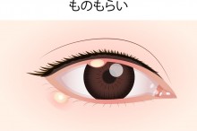 ものもらい コンタクト